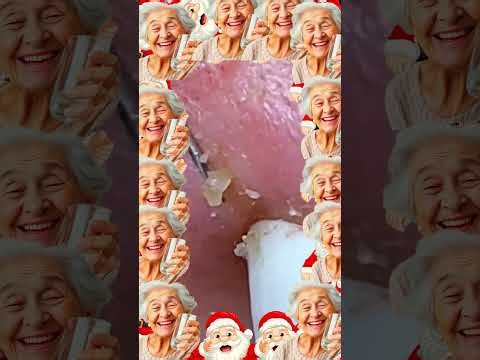Satisfying self-cleaning of blackheads Acne Treatment Pimple pop