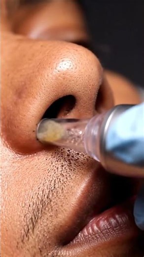 Precision Vacuum Blackhead Removal Nose Edge Wide Macro 4K#shorts #shortvideo #viral #reels #foryou