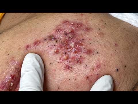 NEW 2026 – Satisfying Deep Pimple Extraction & Blackhead Removal#10371