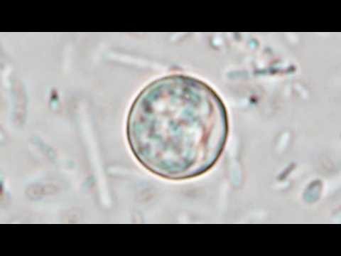 6,571 cyclospora cases in Michigan. Here's what doctors want you to know