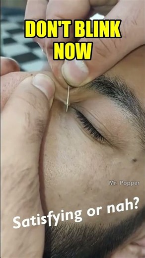 Don't Blink... Eyelid Extraction 😨 #shorts #pimplepopping