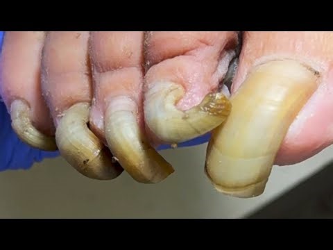 His Toenails Are Extremely Long, He Hasn't Trimmed Them In A Long Time!【Dr Liu's Pedicur】