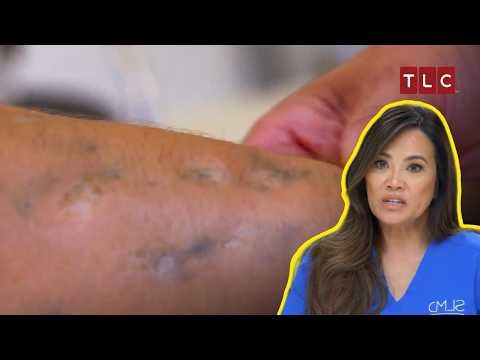 Can Dr. Lee Handle These Massive Bumps? | Dr Pimple Popper S4 | TLC India