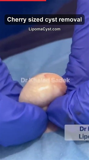 Cherry Cyst Out! Dr Khaled Sadek. LipomaCyst.com