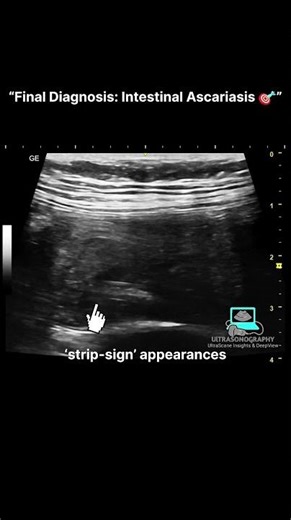 Ultrasound Spots Intestinal Ascariasis 🪱 #Ascariasis #radiology #ultrasound #usg #shorts #shots