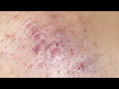 Deep Acne & Blackheads Removal 😱 | Satisfying Pimple Extraction | Skin Care