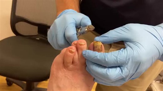 👋 Bye-bye thick, fungal toenails! 🦶💥 Discover expert tips on treating ingrown toenails for smooth, healthy feet! 💅✨ #ToenailTransformation #FootCareTips #ByeFungalNails #IngrownNailSolutions #HealthyFeetJourney 🌟🦶