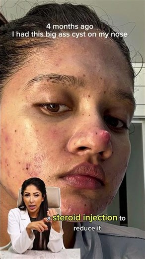 For acne in Skin of Colour use Trio Blemish system www.skincarebydrv.com #shorts