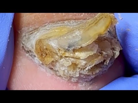 Long And Thick Onychomycosis, Cut Off A Lot Of Fungus【Xue Yidao】