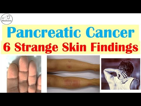 Your Skin Can Reveal Pancreatic Cancer: 6 Critical Clues