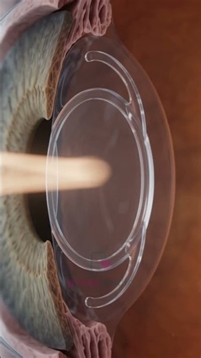 Cataract Surgery Explained: How the Cloudy Lens Is Replaced