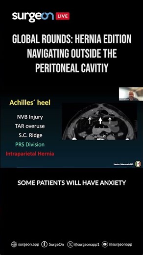 Global Rounds Hernia Edition | Navigating Outside The Peritoneal Cavity