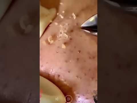 Skincare | Blackheads Removal #847 #tweezers skincare #blackheads blackheads