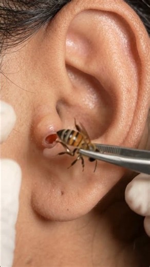 😱 Most Extreme Bug Removal From Ear EVER!
