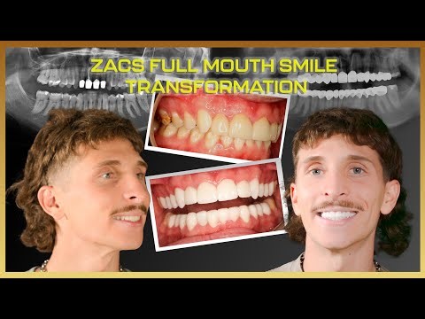 From Hiding His Smile to a New Life: Zac's Full Mouth Journey #dentalcrowns