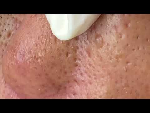Satisfying Pimple Popping Extreme Facial Acne Removal #SkinCareRoutine #poreextraction