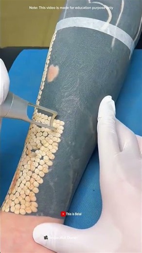A Laser Breaks Tattoo Ink Into Tiny Particles… But What Happens Next?