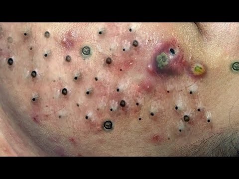 ASMR Skincare | Sac Dep Spa #709 #blackheads #asmr #sacdepspa