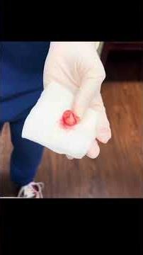 WHATS INSIDE A CYST SAC?