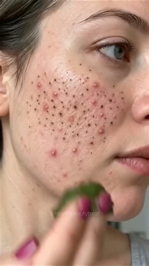 Remove Blackheads Instantly At Home | Get Clear Fair Skin, Get Rid Of Blackheads #blackheads #shorts