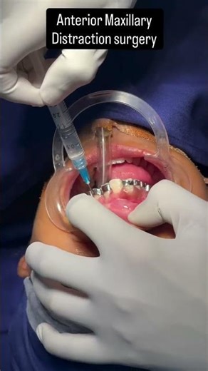 Anterior Maxillary Distraction surgery