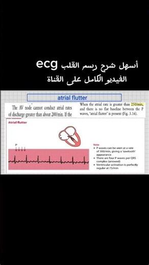 شرح رسم القلب atrial flutter ecg #ecg