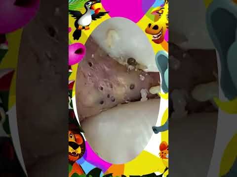 Satisfying self-cleaning of blackheads Acne Treatment Pimple pop