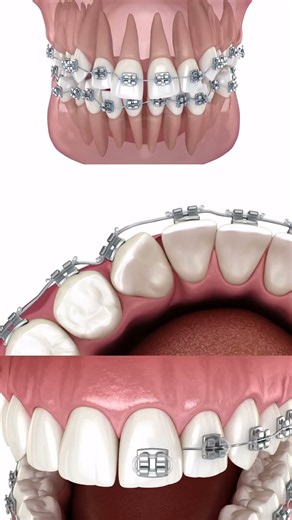 Braces — brackets, wires, gentle force. Crooked → straight. 3D animation.