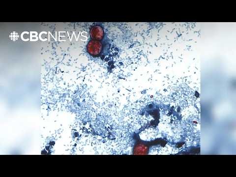 A diarrhea-causing parasite infects more than 1,000 in the U.S.