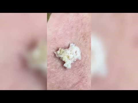 Popping huge blackheads and Pimple Popping - Best Pimple Popping Videos #52