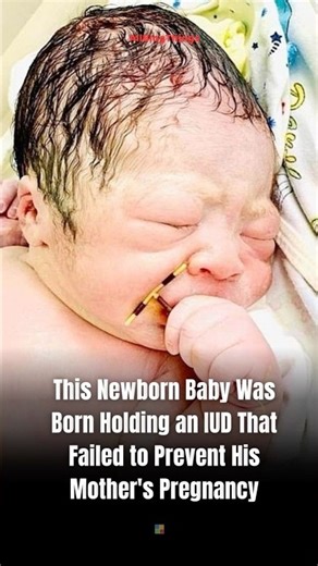 This Newborn Baby Was Born Holding an IUD That Failed to Prevent His Mother’s Pregnancy!