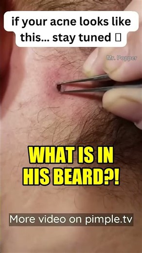 Something Was Stuck In His Beard 😱 #shorts #pimplepopping