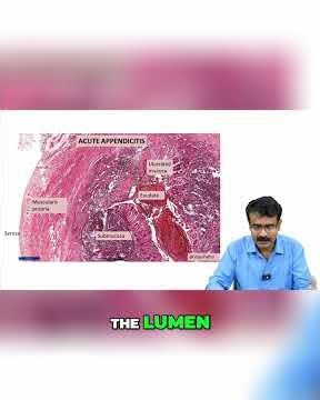 Acute Appendicitis : Neutrophils in Muscularis Propria