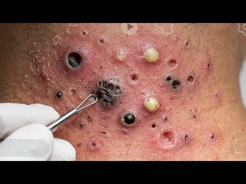 Deep blackhead Removal 2026, acne removal spa, big pimple 2026, #acne #pimple #cyst