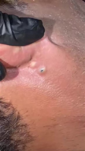 How to Safely Remove a Big Blackhead: Steps and Aftercare