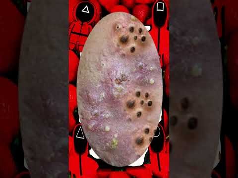 Blackheads Removal #492 | Acne Treatment and Very Satisfying Satisfying Pimple pop #blackheads