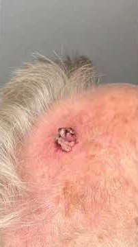 OMG Super Nose Blackheads removal satisfied videos #00