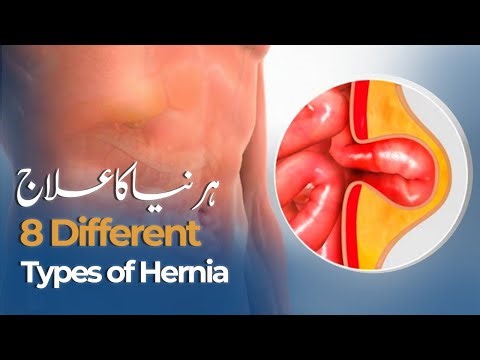 Hernia Kia Hota Hai? - 8 Different Types of Hernia - Symptoms & Treatment in Urdu