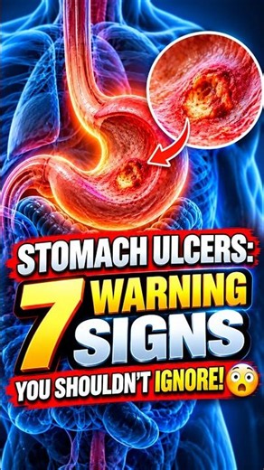 Stomach Ulcers - 7 Warning Signs You Shouldn't Ignore
