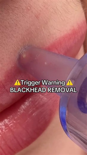 Effective Blackhead Removal Tips for Clear Skin