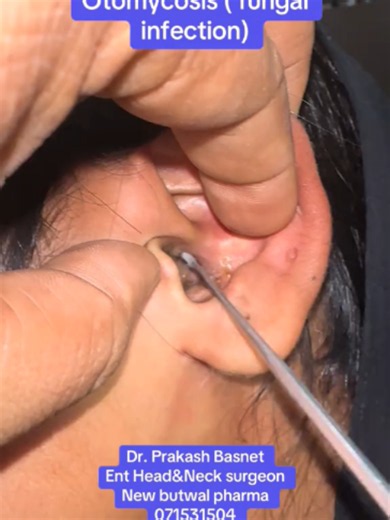 😱 Ear Fungal Infection Removal! 👂 Otomycosis Cleaning Procedure #Otomycosis #EarCleaning #FungalInfection #ENT #MedicalProcedure
