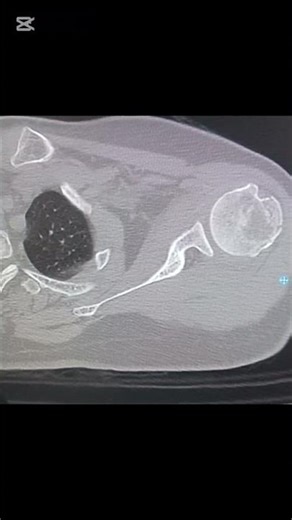 CT scan Shoulder joint Axial slices |Fracture case study #radiographers #scfhs #ctscan #radiologist