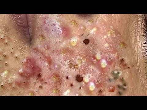 Deep blackhead Removal 2026, acne removal spa, big pimple 2026, #acne #pimple #cyst