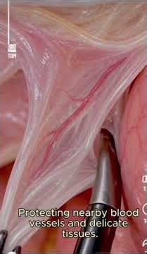 How an Inguinal Hernia is Repaired - Laparoscopic Surgery Explained