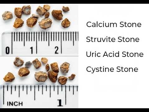 Types of Kidney Stones ; Calcium, Struvite, Uric, Cystine, Calcium Oxalate, Calcium Phosphate
