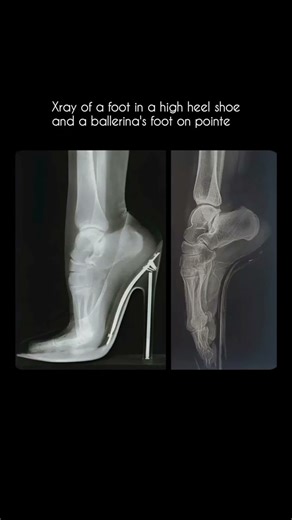 High Heels vs Ballet Xray comparison #interesting