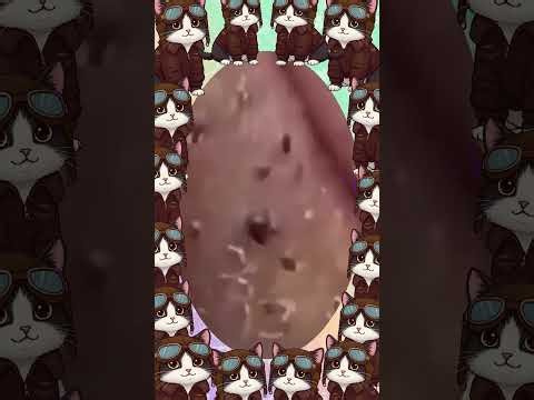Satisfying self-cleaning of blackheads Acne Treatment Pimple pop