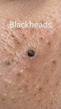 #BlackheadExtraction #Satisfying 【Blackhead Extraction ASMR | Clean & Smooth】