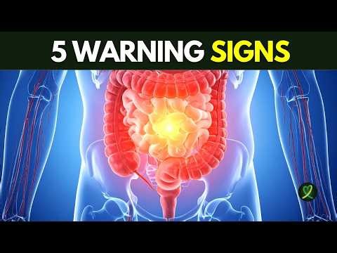 5 Signs and Symptoms of Colon Cancer
