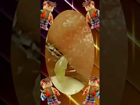 Blackheads Removal #297 | Acne Treatment and Very Satisfying Satisfying Pimple pop #blackheads